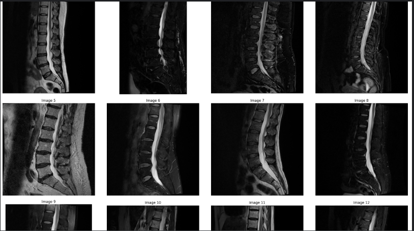 Predictind servierness of lumbar deseases